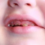 La carie e dentini da latte: pericoli da evitare e come capire che il dentino è cariato. Fluoro: a che cosa serve
