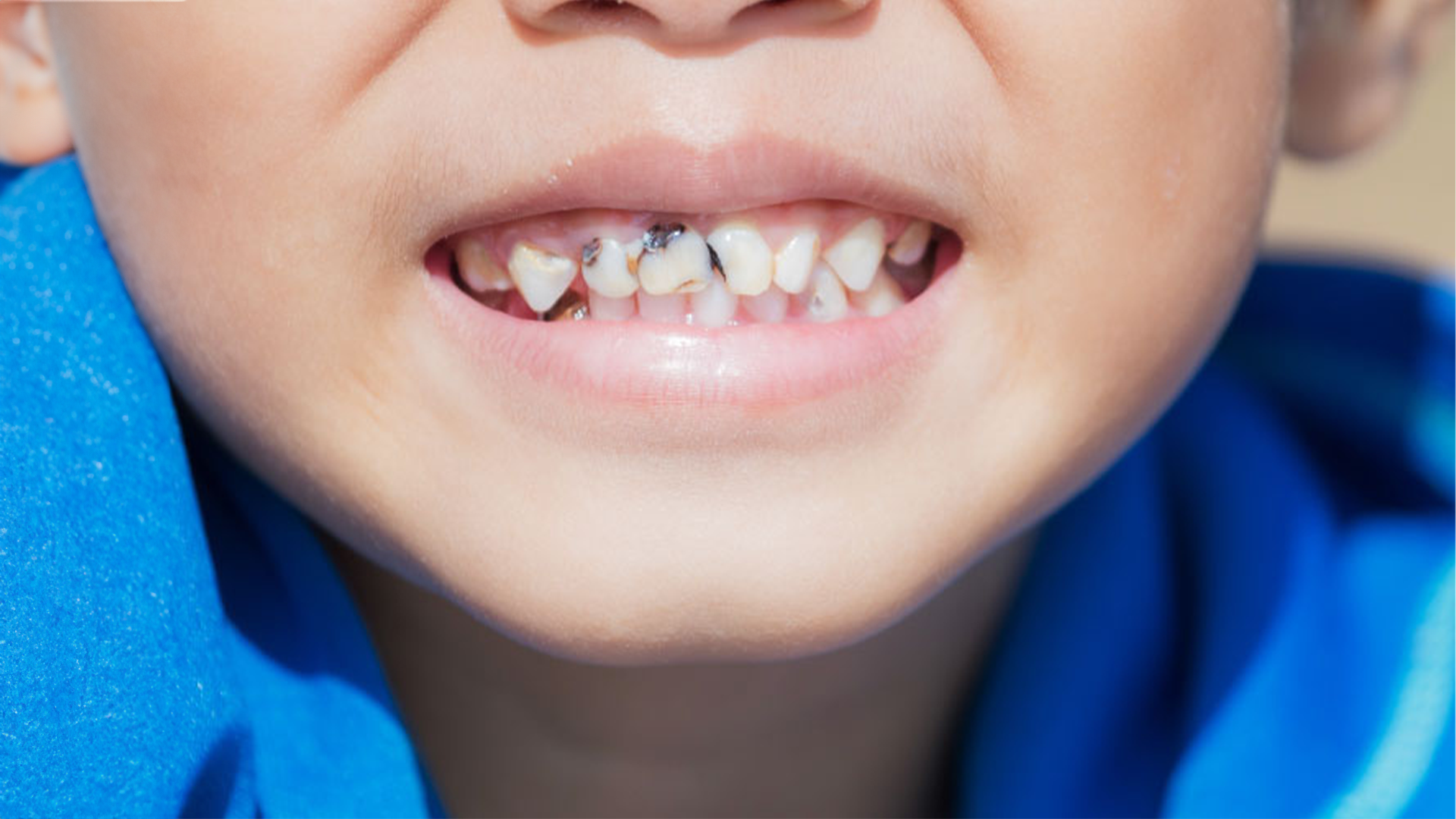 Carie e denti da latte: come prevenirle e riconoscerle tempestivamente