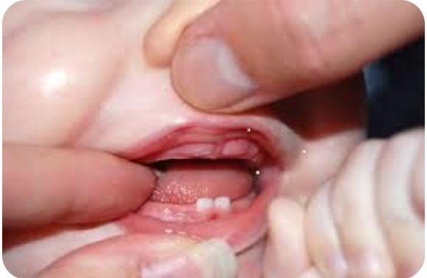 Dentizione neonato: calendario e sintomi dei primi dentini