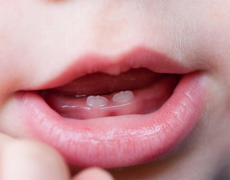 La dentizione da latte: tempi di eruzione, importanza dei dentini, segnali  che il dentino sta spuntando - Baby Wellness Foundation