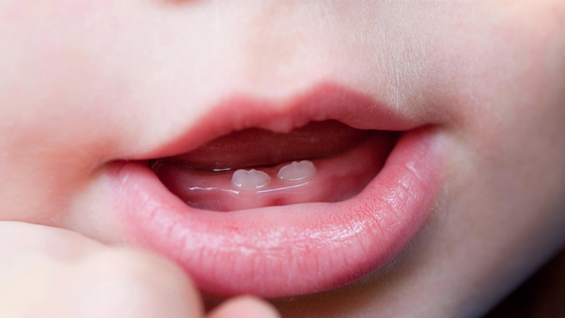 La dentizione decidua: sviluppo, funzioni e segnali dell’eruzione nei bambini