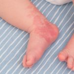 Anatomia e vulnerabilità della pelle neonatale