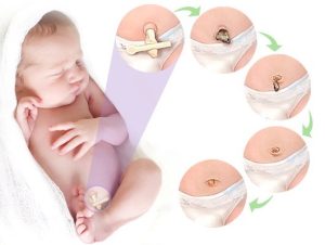 Figure 1: Stages of the umbilical cord mummification process